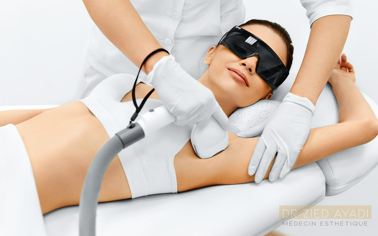 Epilation laser