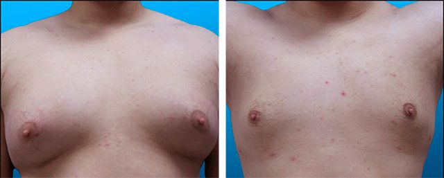 Before After - Liposuccion du torse 
